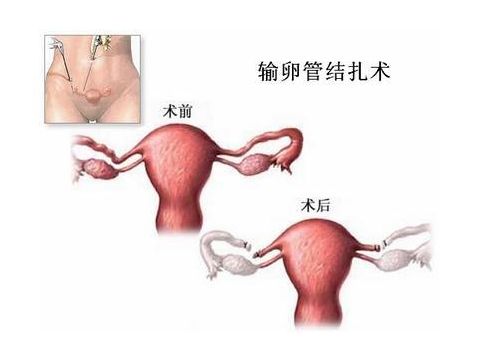 胎儿停止发育